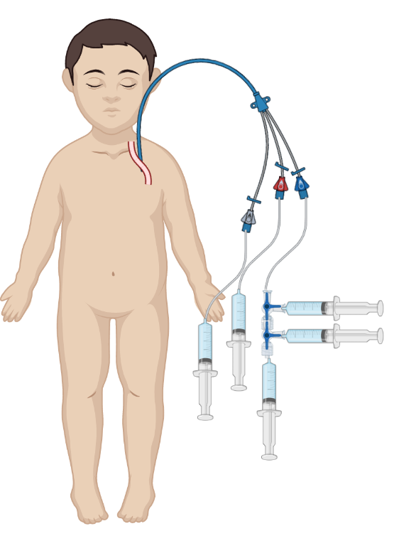 Illustration of a newborn baby with several tubes attached