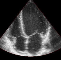 An ultrasound image showing the four heart chambers